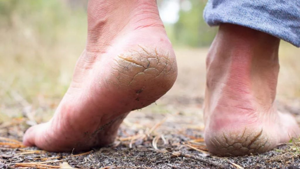 Dry Feet