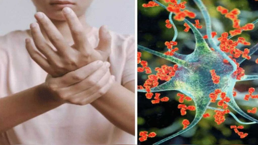 Guillain Barre Syndrome