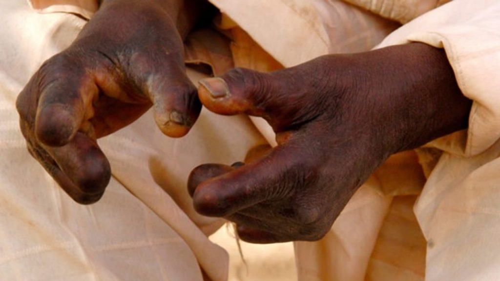 Leprosy