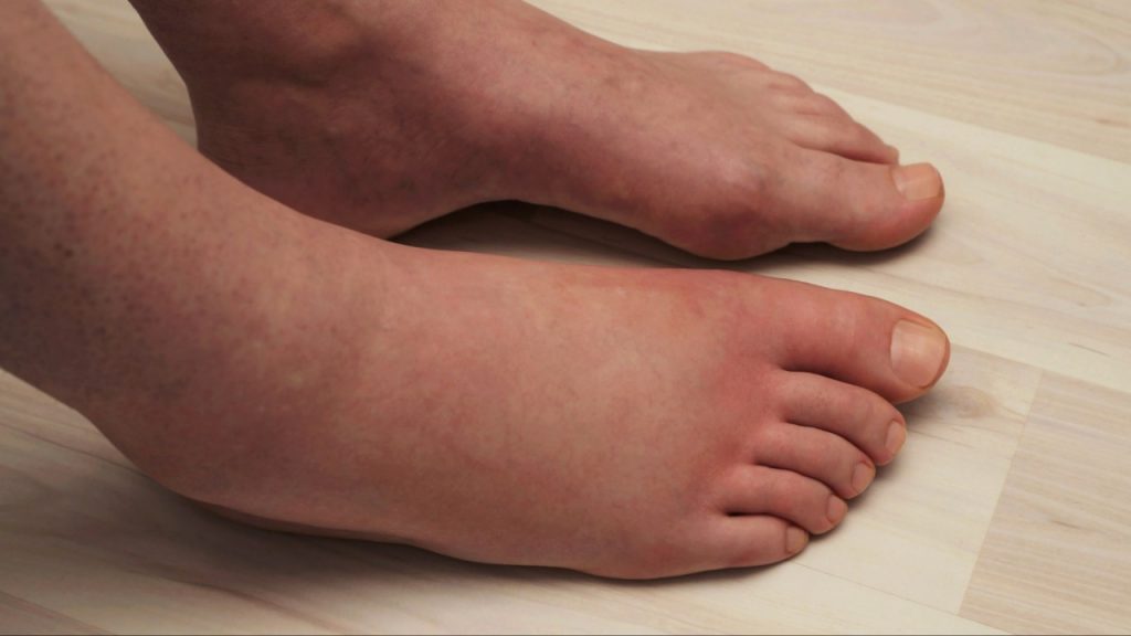 Swollen Foot