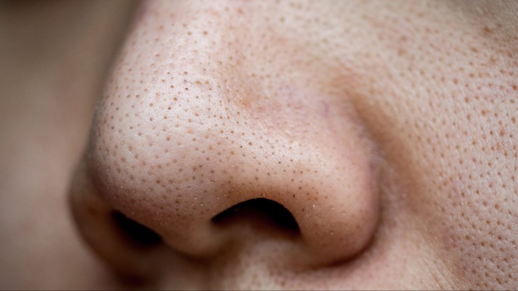 Black Heads