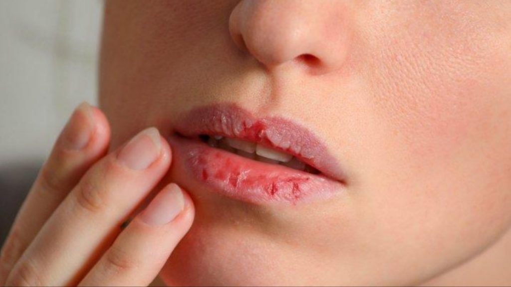 Dry Lips