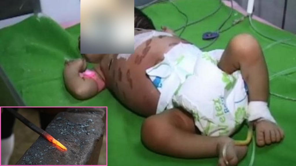 Infant Branded With Hot Iron Odisha Iron Rod Vs Infant Treatment