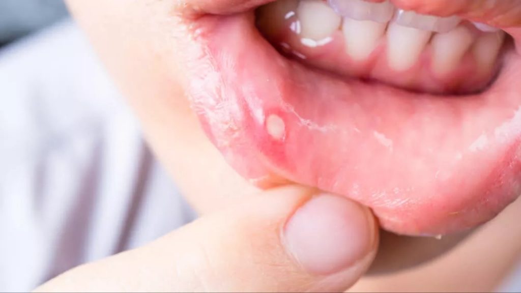 Mouth Ulcer
