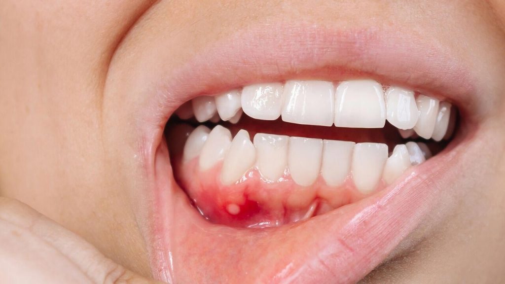 Oral Cancer