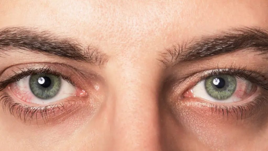 eye allergy