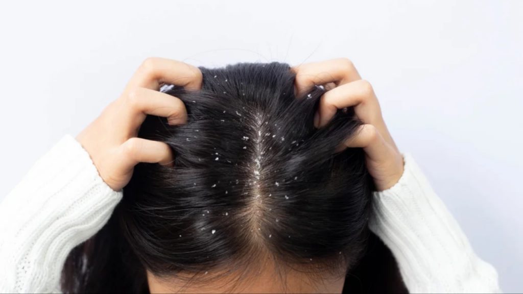 Dandruff
