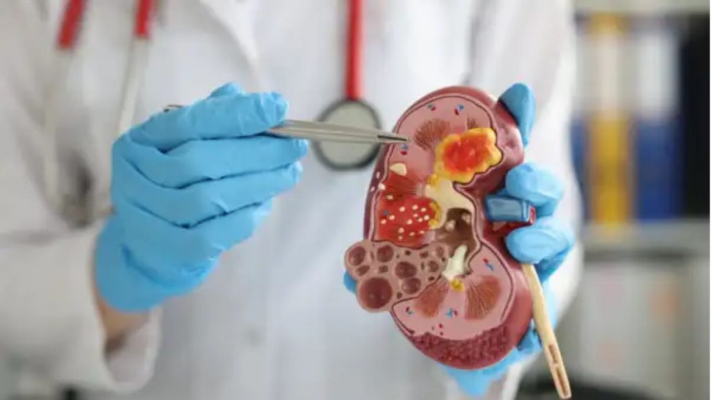 Kidney Stones Risks Facts Delhi Aiims Research