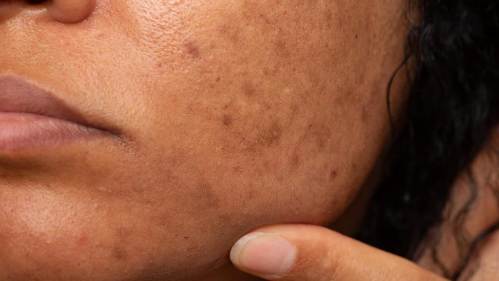 Pigmentation