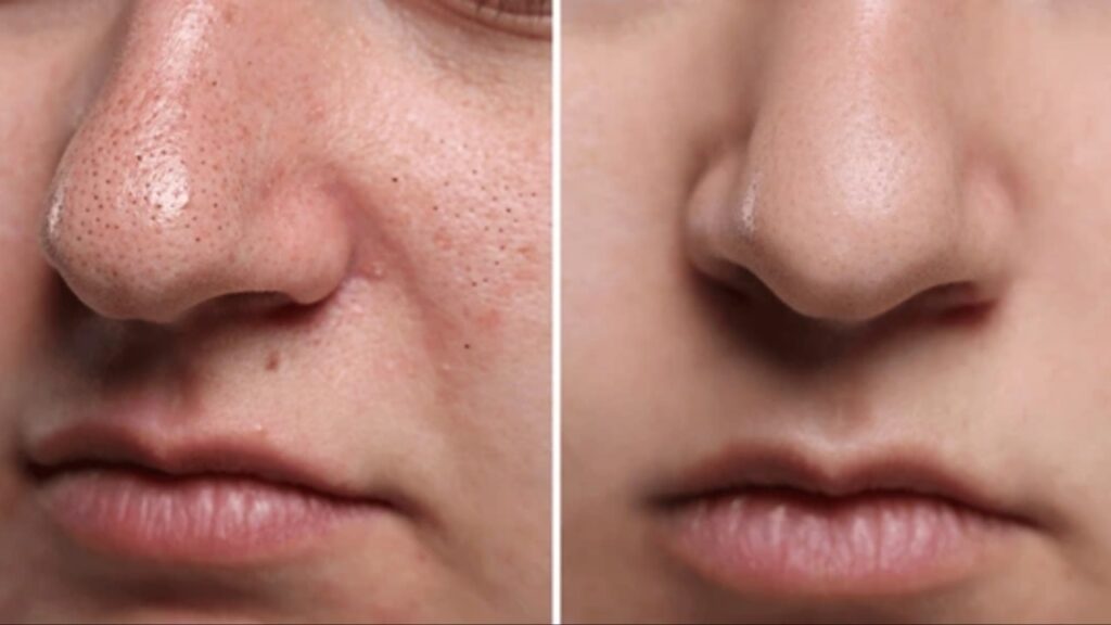 Black Heads
