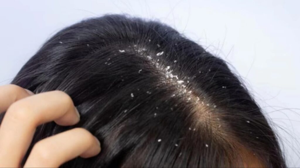 Dandruff