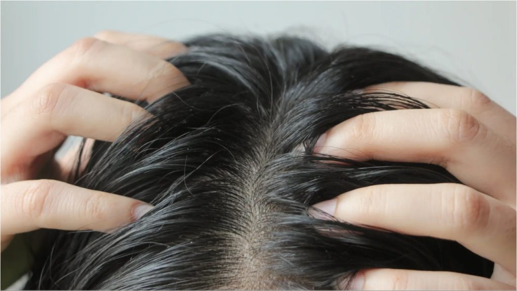 Dandruff