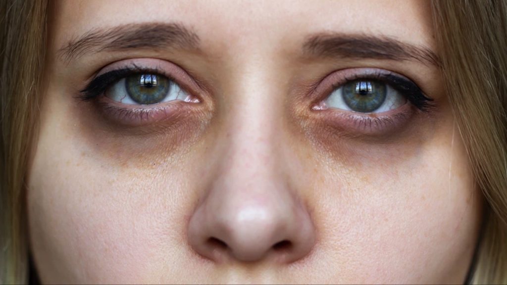 Dark Circles