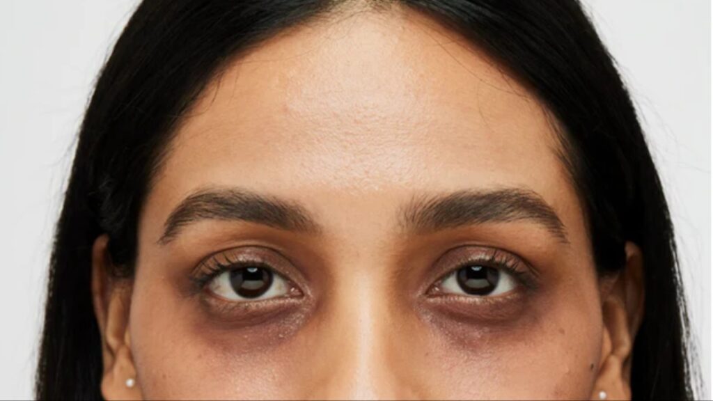 Dark Circles