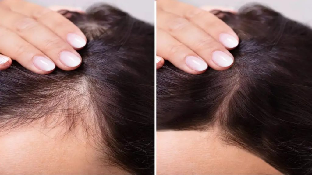 Hair Loss