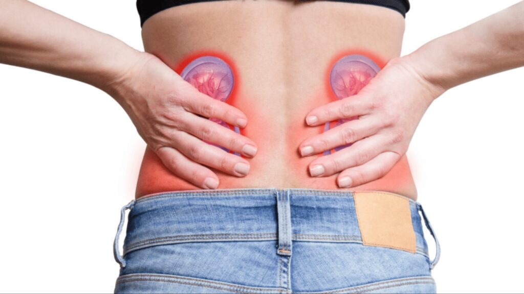Kidney Stones
