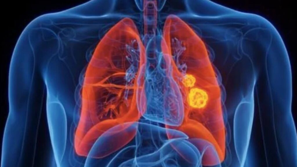 Lung Cancer