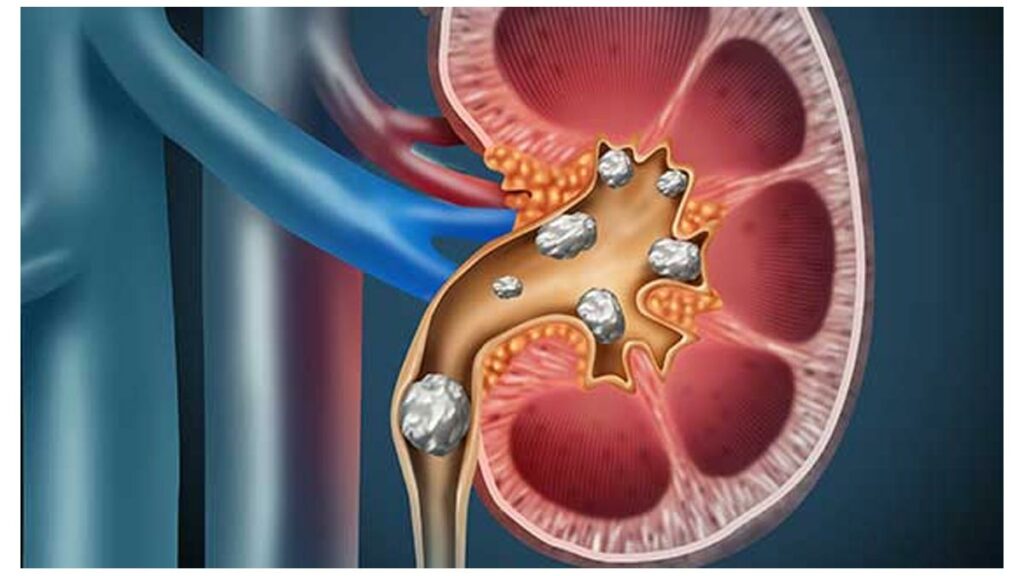 Kidney Stones