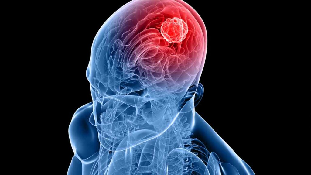 Brain Tumor