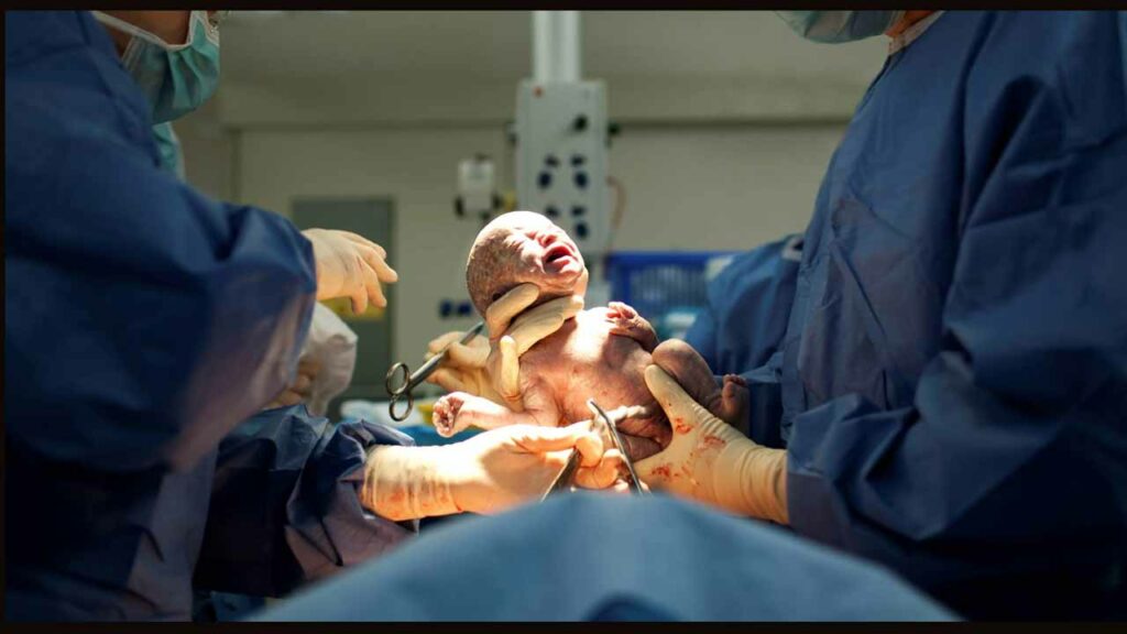 Cesarean Deliveries