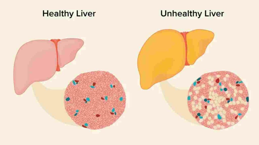 Fatty Liver