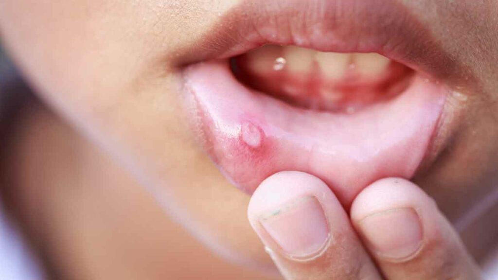Mouth Ulcers